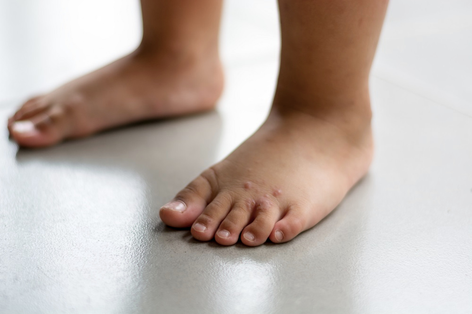 Wratten behandelen bij je kind Ouders van Nu
