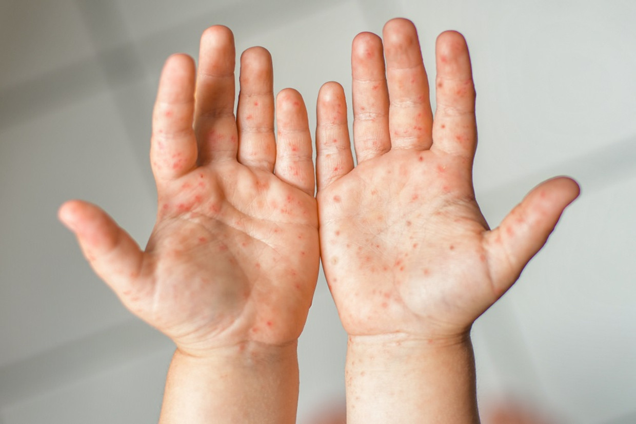 Hand, voet en mondziekte bij kinderen Ouders van Nu